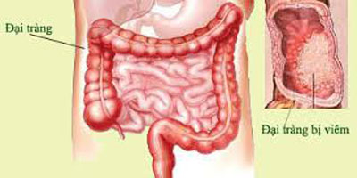Bệnh viêm đại tràng